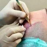 hair-transplant-surgery-150x150